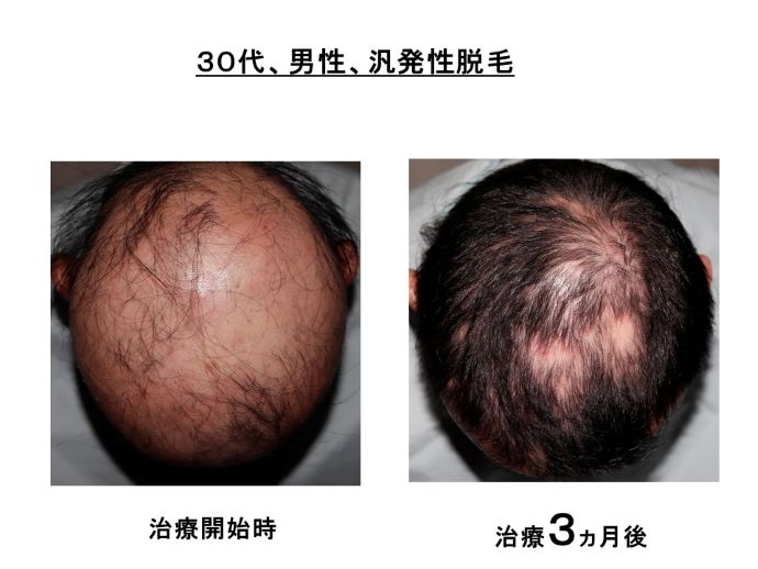 円形脱毛症　病院